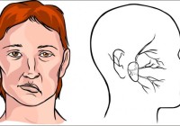 Gejala dan Tanda Stroke yang Sering Dibiarkan