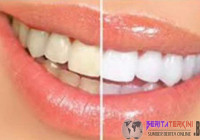 Hanya 2 Menit Gigi Kamu Yang Dulu Kuning Menjadi Cemerlang