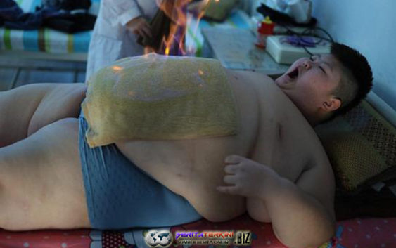 Bocah Asal Tiongkok Lakukan Terapi Api Karena Obesitas